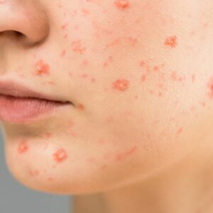 Acne Treatment