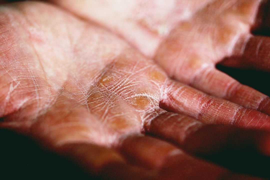 how to stop eczema itching